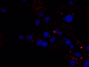 PANC-1 Pancreatic Cancer cells